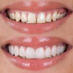 Faccette Dentali: sorriso perfetto e naturale