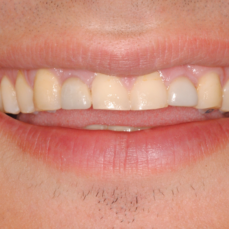 Trasforma il tuo sorriso con le faccette dentali