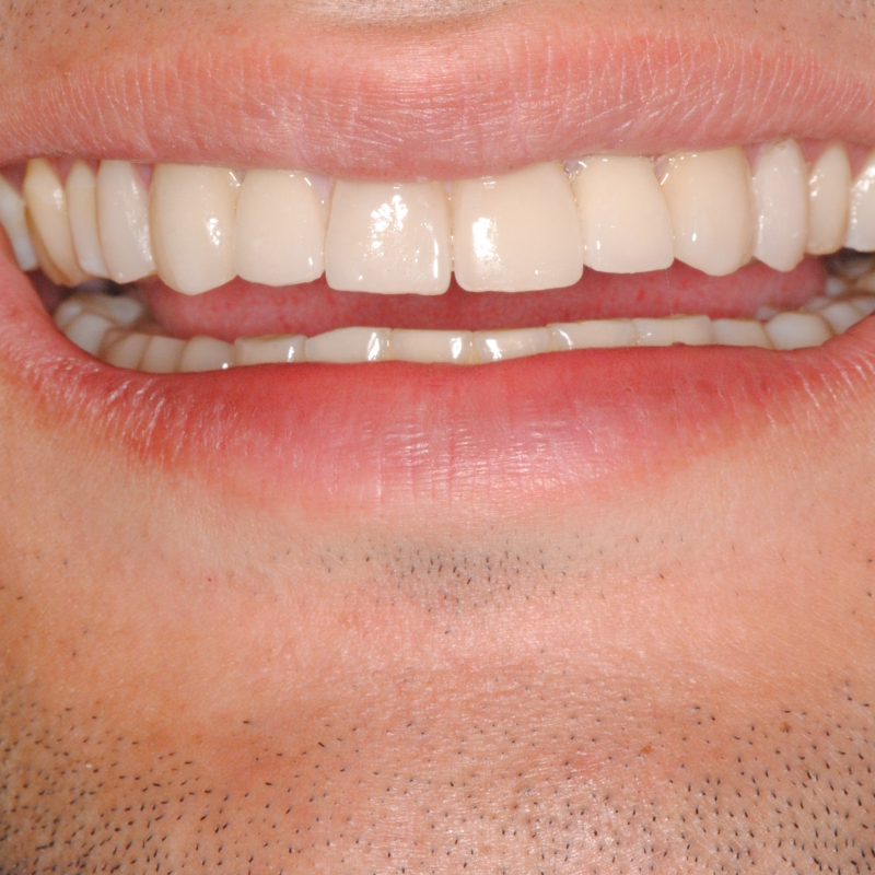 Estetica dentale: faccette per un sorriso perfetto