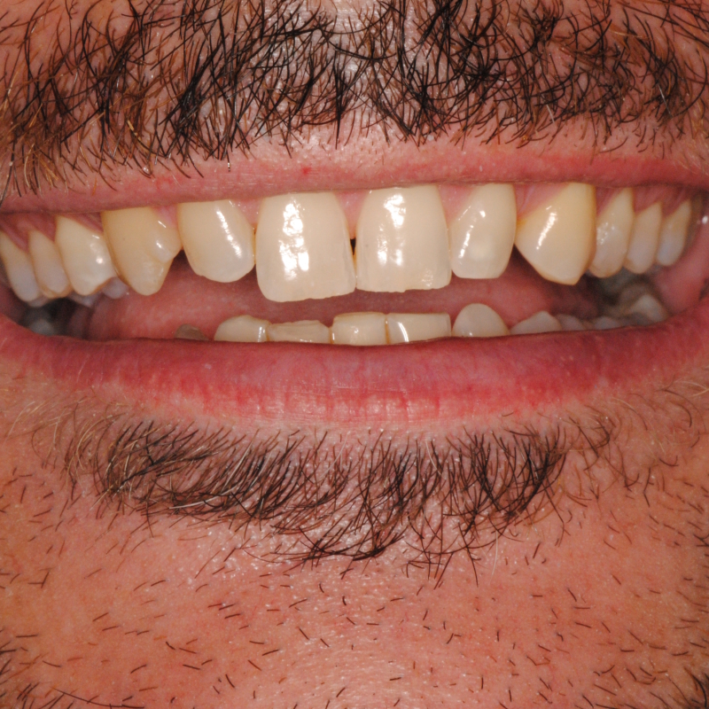 Faccette dentali professionali – il sorriso dei tuoi sogni