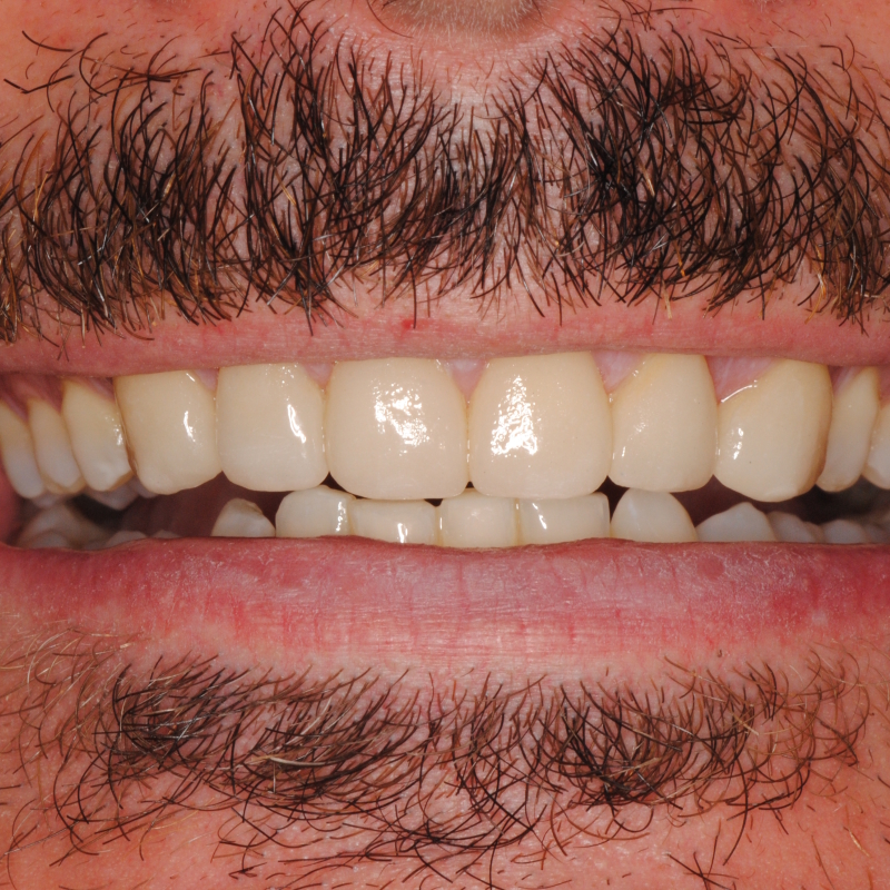 Soluzioni di odontoiatria estetica con faccette dentali