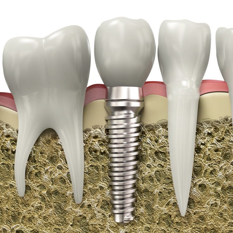 Galleria implantologia dentale