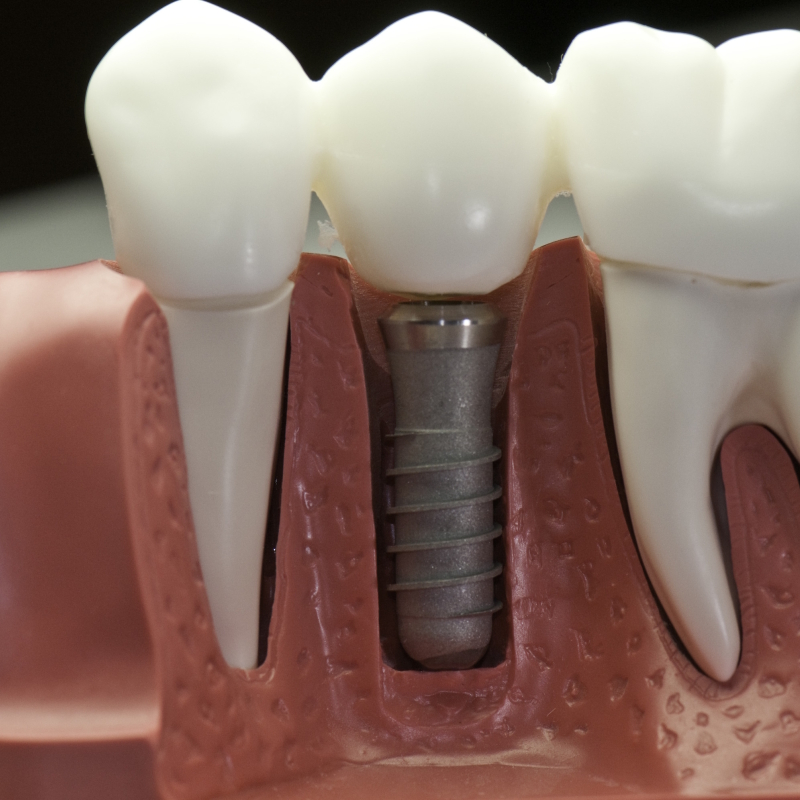 Foto trattamento implantologico – Roma EUR