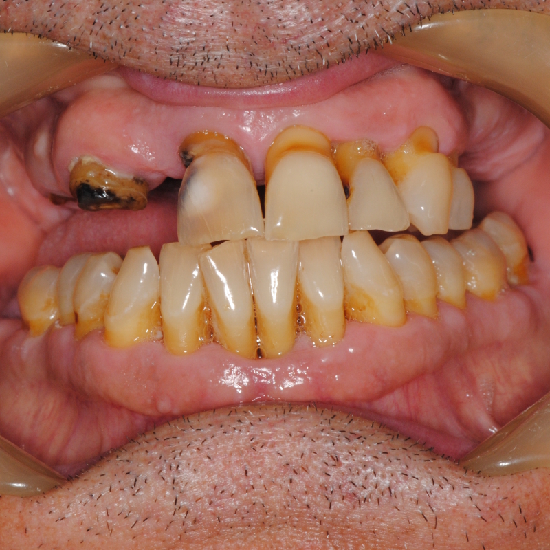 Trattamenti implantologici