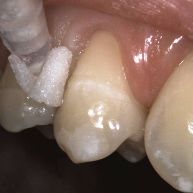 Interventi di odontoiatria conservativa precisi e indolori per la cura dei denti danneggiati.