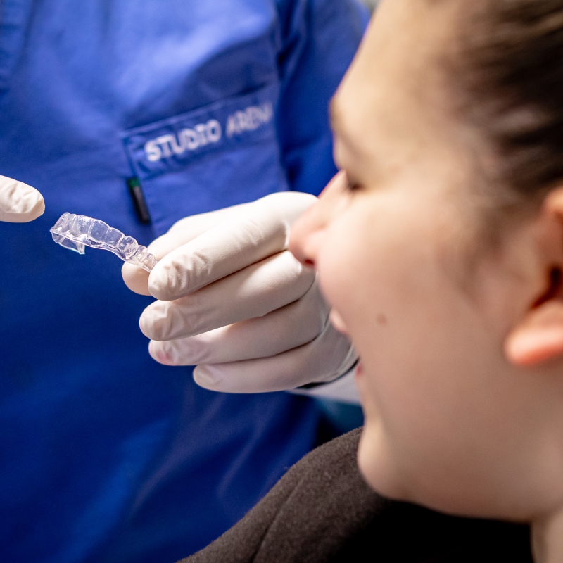 Prima e dopo trattamento con ortodonzia invisibile per l’allineamento dei denti