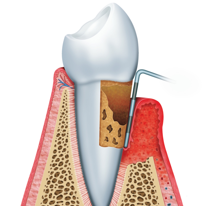 Salute orale: benefici della parodontologia professionale