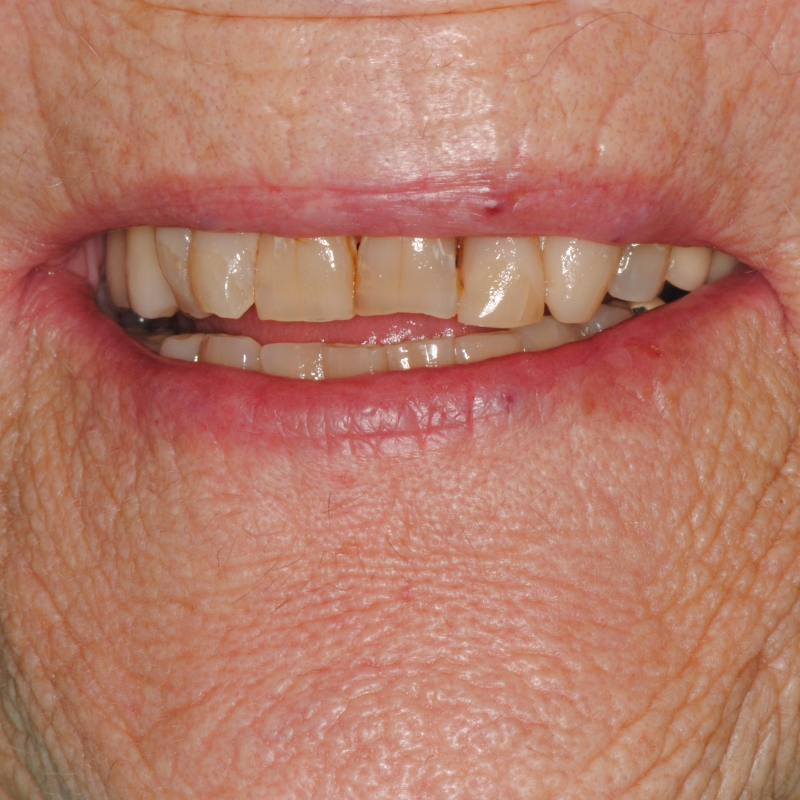 Protesi dentaria completa per arcata superiore con risultato naturale e armonios