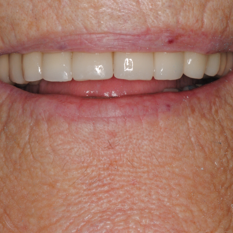 Protesi dentaria parziale per sostituzione di denti mancanti e miglioramento della masticazione