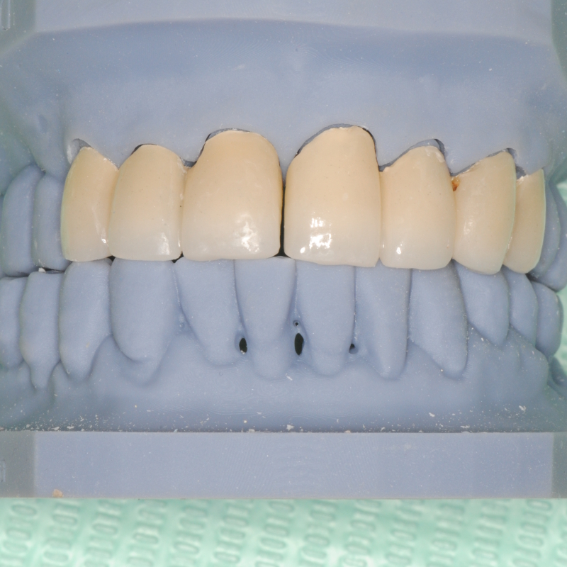 Confronto prima e dopo trattamento con protesi dentarie estetiche