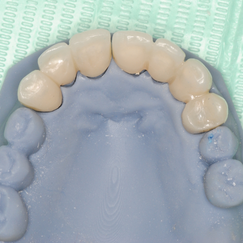 Protesi dentaria rimovibile progettata per garantire comfort e funzionalità quotidiana