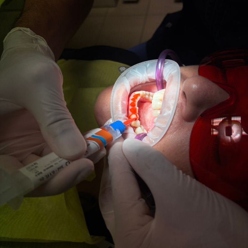 Restauro estetico dei denti anteriori nello studio a Roma EUR”