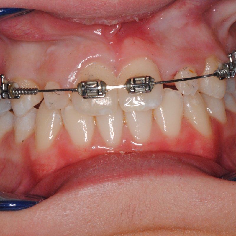 Trattamento estetico dei denti con risultati naturali a Roma EUR