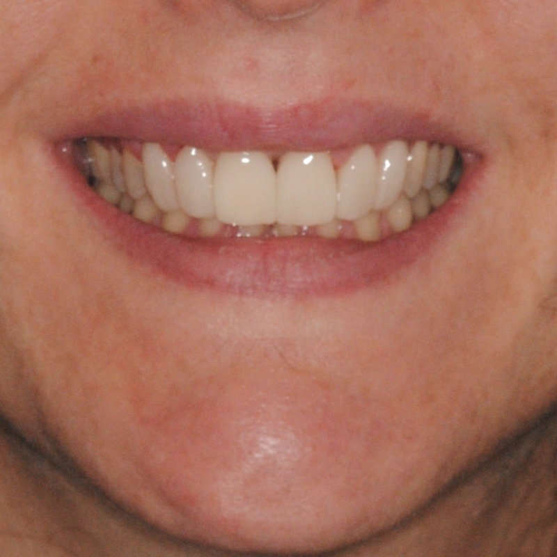 Faccette dentali applicate per migliorare il sorriso a Roma EUR