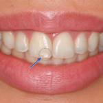 Macchie bianche sui Denti, White Spot: trattamento con Resina Infiltrante senza trapano